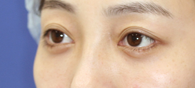 新宿ラクル美容外科クリニック　山本厚志　下眼瞼下制術（グラマラスライン形成術（皮膚切開法））+目尻切開+目頭切開　手術後２ヶ月目　３月１日