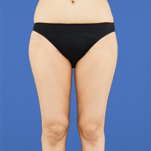 新宿ラクル美容外科クリニック　山本厚志　「ライポライフ脂肪吸引（お尻＋太もも全体＋ひざ周り）」　手術後６ヶ月目　３月３１日
