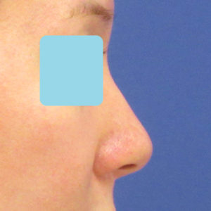 「鼻孔縁下降術」　新宿ラクル美容外科クリニック　３０代女性　手術後６ヶ月目　３月１１日
