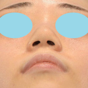 新宿ラクル美容外科クリニック　山本厚志　「小鼻縮小+α法」　手術後１２ヶ月目　９月９日
