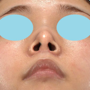 新宿ラクル美容外科クリニック　山本厚志　「小鼻縮小+α法」　手術後１ヶ月目　４月６日