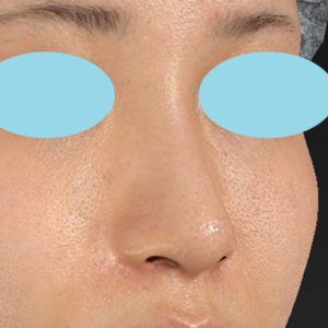 新宿ラクル美容外科クリニック　山本厚志　「小鼻縮小+α法」　手術後２ヶ月目　６月１６日
