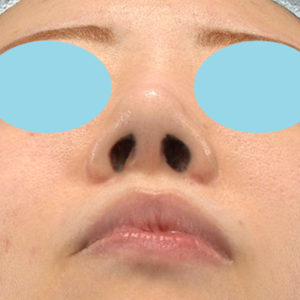 「耳介軟骨移植＋鼻尖縮小（close法）＋他院鼻プロテーゼ抜去」　新宿ラクル美容外科クリニック　２０代女性　手術後１ヶ月目　５月１９日