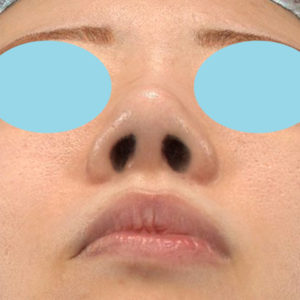 「耳介軟骨移植＋鼻尖縮小（close法）＋他院鼻プロテーゼ抜去」　新宿ラクル美容外科クリニック　２０代女性　手術後２ヶ月目　５月１９日