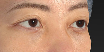 新宿ラクル美容外科クリニック　山本厚志　切らない目の下のたるみ取り+ヒアルロン酸　30代女性　 手術後２ヶ月目