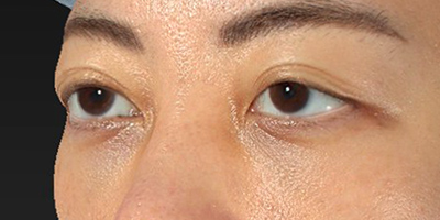 新宿ラクル美容外科クリニック　山本厚志　切らない目の下のたるみ取り+ヒアルロン酸　30代女性　 手術後１ヶ月目