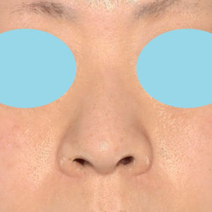 「小鼻縮小+α＋鼻尖縮小（close法）」　新宿ラクル美容外科クリニック　４０代女性　手術前　１１月１５日