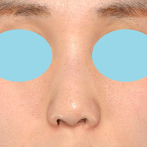 「耳介軟骨移植＋鼻尖縮小（close法）」　新宿ラクル美容外科クリニック　２０代女性　手術前　６月２８日