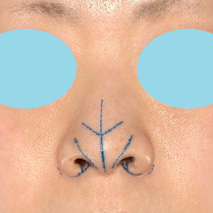 「小鼻縮小+α＋鼻尖縮小（close法）」　新宿ラクル美容外科クリニック　４０代女性　デザイン　１１月１５日