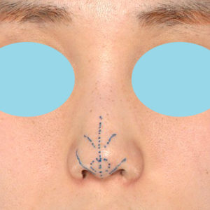 「耳介軟骨移植＋鼻尖縮小（close法）」　新宿ラクル美容外科クリニック　２０代女性　デザイン　６月２８日