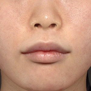新宿ラクル美容外科クリニック　山本厚志　「口角挙上（スマイルリップ）+ 人中短縮術（リップリフト）」　手術後１２ヶ月目　６月２８日