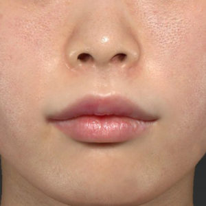 新宿ラクル美容外科クリニック　山本厚志　「口角挙上（スマイルリップ）+ 人中短縮術（リップリフト）」　手術後６ヶ月目　１２月２０日