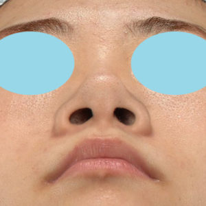 新宿ラクル美容外科クリニック　山本厚志　「小鼻縮小+α法」　手術前　６月１１日