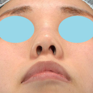 「耳介軟骨移植＋鼻尖縮小（close法）」　新宿ラクル美容外科クリニック　２０代女性　手術前　６月２８日