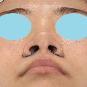 新宿ラクル美容外科クリニック　山本厚志　「小鼻縮小+α法」　デザイン　６月１１日