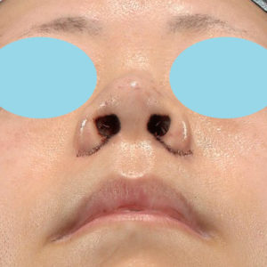 「小鼻縮小+α＋鼻尖縮小（close法）」　新宿ラクル美容外科クリニック　４０代女性　手術直後　１１月１５日