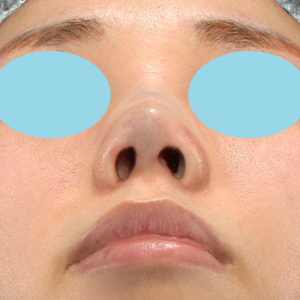 「耳介軟骨移植＋鼻尖縮小（close法）」　新宿ラクル美容外科クリニック　２０代女性　手術直後　６月２８日