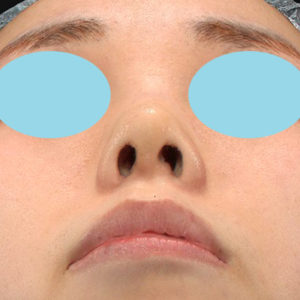 「耳介軟骨移植＋鼻尖縮小（close法）」　新宿ラクル美容外科クリニック　２０代女性　手術後１週間目　６月２８日