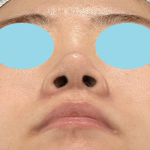新宿ラクル美容外科クリニック　山本厚志　「小鼻縮小+α法」　手術後１２ヶ月目　１２月２日
