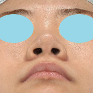 新宿ラクル美容外科クリニック　山本厚志　「小鼻縮小+α法」　手術後１ヶ月目　６月１１日