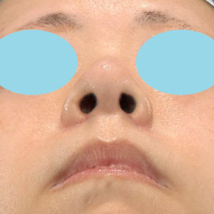 「小鼻縮小+α＋鼻尖縮小（close法）」　新宿ラクル美容外科クリニック　４０代女性　手術後１ヶ月目　１１月１５日