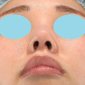 「耳介軟骨移植＋鼻尖縮小（close法）」　新宿ラクル美容外科クリニック　２０代女性　手術後１ヶ月目　６月２８日