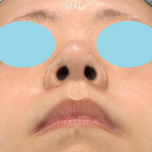「小鼻縮小+α＋鼻尖縮小（close法）」　新宿ラクル美容外科クリニック　４０代女性　手術後２ヶ月目　１１月１５日