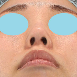 「耳介軟骨移植＋鼻尖縮小（close法）」　新宿ラクル美容外科クリニック　２０代女性　手術後２ヶ月目　６月２８日