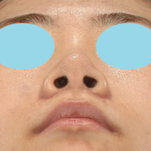 新宿ラクル美容外科クリニック　山本厚志　「小鼻縮小+α法」　手術後３ヶ月目　６月１１日