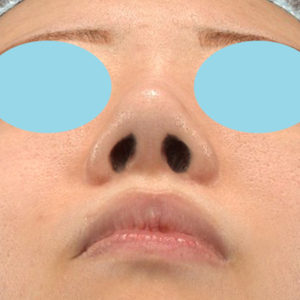 「耳介軟骨移植＋鼻尖縮小（close法）＋他院鼻プロテーゼ抜去」　新宿ラクル美容外科クリニック　２０代女性　手術後３ヶ月目　６月１７日