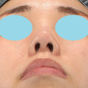 「耳介軟骨移植＋鼻尖縮小（close法）」　新宿ラクル美容外科クリニック　２０代女性　手術後３ヶ月目　６月２８日