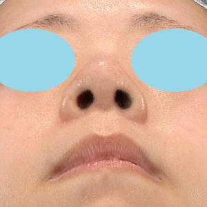 「小鼻縮小+α＋鼻尖縮小（close法）」　新宿ラクル美容外科クリニック　４０代女性　手術後３ヶ月目　７月１１日
