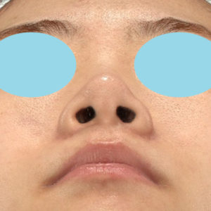 新宿ラクル美容外科クリニック　山本厚志　「小鼻縮小+α法」　手術後６ヶ月目　６月１１日