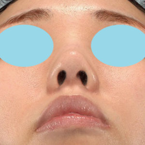 「耳介軟骨移植＋鼻尖縮小（close法）」　新宿ラクル美容外科クリニック　２０代女性　手術後６ヶ月目　１０月２５日