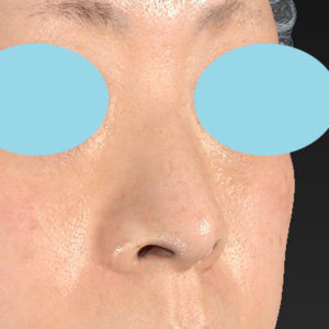 「小鼻縮小+α＋鼻尖縮小（close法）」　新宿ラクル美容外科クリニック　４０代女性　手術前　１１月１５日