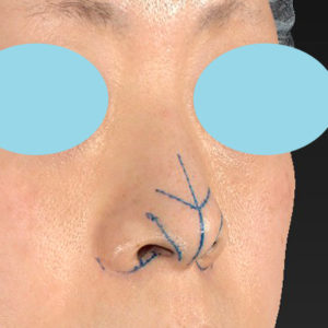 「小鼻縮小+α＋鼻尖縮小（close法）」　新宿ラクル美容外科クリニック　４０代女性　デザイン　１１月１５日
