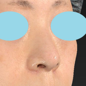 「小鼻縮小+α＋鼻尖縮小（close法）」　新宿ラクル美容外科クリニック　４０代女性　手術後１ヶ月目　１１月１５日