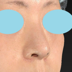 「小鼻縮小+α＋鼻尖縮小（close法）」　新宿ラクル美容外科クリニック　４０代女性　手術後２ヶ月目　１１月１５日