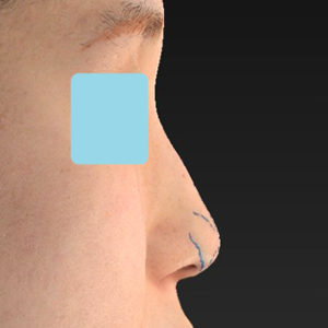 「耳介軟骨移植＋鼻尖縮小（close法）」　新宿ラクル美容外科クリニック　２０代女性　デザイン　６月２８日