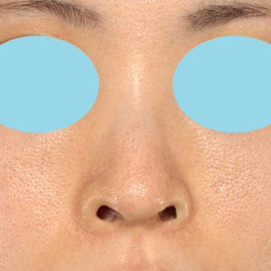 「鼻孔縁下降術」　新宿ラクル美容外科クリニック　３０代女性　手術前　１月２４日