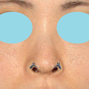 「鼻孔縁下降術」　新宿ラクル美容外科クリニック　３０代女性　デザイン　７月１７日