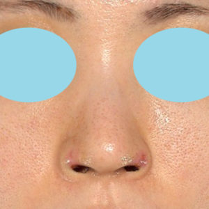 「鼻孔縁下降術」　新宿ラクル美容外科クリニック　３０代女性　手術後１週間目　７月１７日