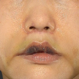 「鼻孔縁下降術」「人中短縮」　新宿ラクル美容外科クリニック　３０代女性　手術後１週間目　７月２３日