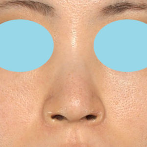 「鼻孔縁下降術」　新宿ラクル美容外科クリニック　３０代女性　手術後１ヶ月目　７月１７日