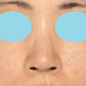 「鼻孔縁下降術」　新宿ラクル美容外科クリニック　３０代女性　手術後２ヶ月目　７月１７日