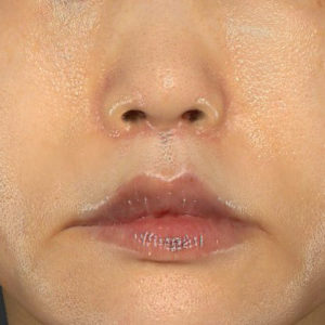 「鼻孔縁下降術」「人中短縮」　新宿ラクル美容外科クリニック　３０代女性　手術後２ヶ月目　７月２３日
