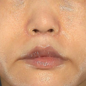 「鼻孔縁下降術」「人中短縮」　新宿ラクル美容外科クリニック　３０代女性　手術後３ヶ月目　７月２３日