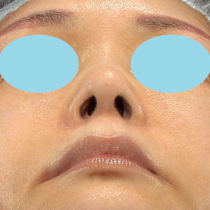 「鼻孔縁下降術」「人中短縮」　新宿ラクル美容外科クリニック　３０代女性　手術前　７月２３日
