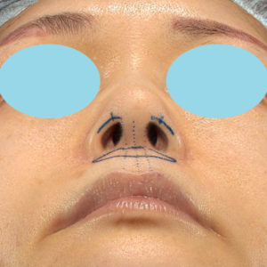 「鼻孔縁下降術」「人中短縮」　新宿ラクル美容外科クリニック　３０代女性　デザイン　７月２３日