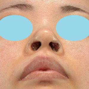 「鼻孔縁下降術」　新宿ラクル美容外科クリニック　３０代女性　手術直後　７月１７日